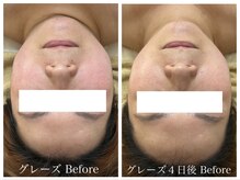 ルルボーテ(Loulou Beaute)/グレーズソフトピール