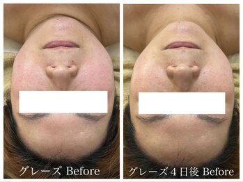 ルルボーテ(Loulou Beaute)/グレーズソフトピール