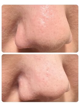 サロン エムイー(Salon ME)/毛穴ケア