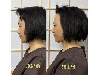 アキュピタル(acupital)/美容鍼灸 BeforeAfter