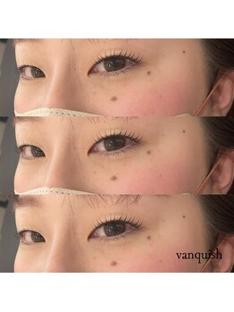 バンクィッシュ(vanquish)/似合わせカール/まつぱ