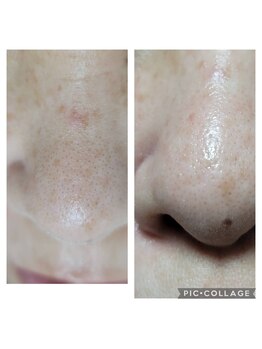 エスボーテ(sbeaute)/お鼻の黒ずみ