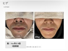 リネ(Rine)/before→after