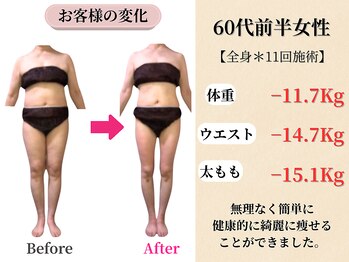 ベルホワイト(Belle White)/【60代前半/4ヶ月の変化】