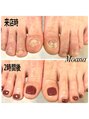 モアナ 池袋(MOANA)&nbsp;即日見た目改善しながら深爪を綺麗な爪に育てていきます。
