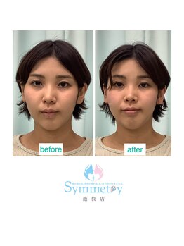 シンメトリー 池袋店/小顔矯正ビフォーアフター