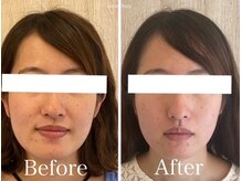 サロンベイビー 西宮本店(Salon Baby)/【BeforeAfter】小顔美容整顔