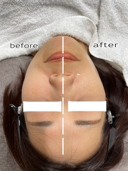 エンチャント(ENCHANT)/ウルトラお顔超音波リフト