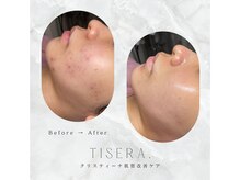 ティセラ(TISERA.)/ニキビケア/毛穴開き/赤み