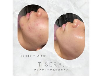 ティセラ(TISERA.)/ニキビケア/毛穴開き/赤み