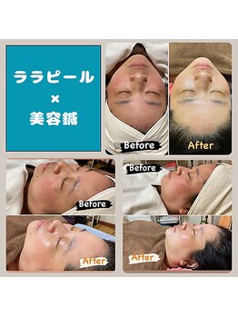 ホジュン鍼灸整体院/ララピール+美容鍼