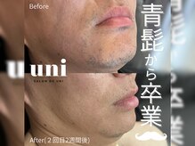 サロン ド ユニ(SALON DE UNI)の雰囲気（ハイブリットひげ脱毛！２回目３回目と繰り返すごとに驚く抜け感）
