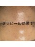 人気NO1/ララピール進化/セラピール&脱毛&毛穴超音波洗浄×パックLDM ¥11000 