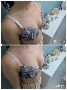 美人バスト 柏店/【バストアップ・育乳】症例