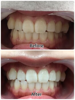 ドクターモック(Dr.MOC)/ＢＥＦＯＲＥ→ＡＦＴＥＲ