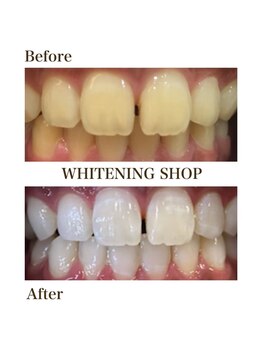 ホワイトニングショップ 高岡店/beforeafter