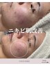 ニキビケア肌質改善】素肌に自信が付く話題のハーブピーリングで肌質改善