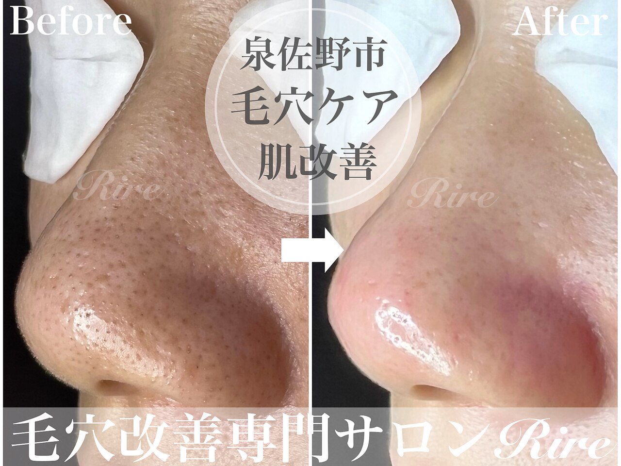 泉佐野市で毛穴ケアが人気のエステサロン｜ホットペッパービューティー