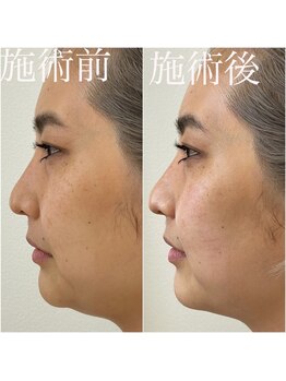 リリールレーブ(LiLy Le Reve)/小顔矯正