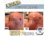 黒ずみ毛穴、ひらき毛穴改善【プラズマフェイシャル＋毛穴洗浄】