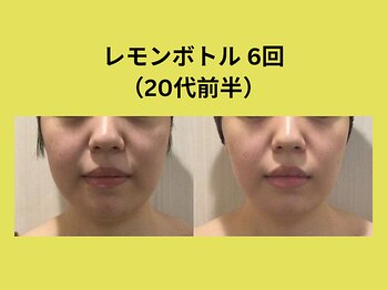 アユアランリンク 札幌店/レモンボトル/20代前半/6回