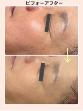 リファイン(REFINE)/小顔、目元のシワも改善！