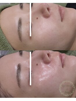 ココホワイトニング(coco whitening)/【小鼻毛穴改善】