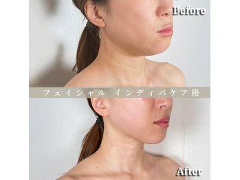 術後の女神 大阪本町店/ダウンタイムケア・インディバ