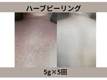 ウィズサロン(withサロン)の雰囲気(ニキビケアやお背中/当店のハーブピーリングでお悩みを◎)