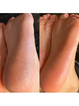 メロウサンセット(Mellow Sunset)/かかと角質ケア