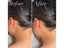 インベスト(INVEST)/うなじ脱毛