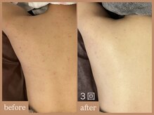 リムーン 岡崎(Re'moon)/REVI ハーブピーリング　お背中