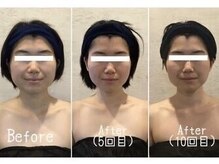 小顔フェイスラボ 袋井店(小顔FaceLabo.)/◆小顔コルギ Before→After◆