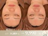 韓国最新RFサーマジ【小顔・Vライン形成】ほうれい線、二重あご改善¥9,990