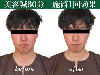 もみの木鍼灸整骨院 恵比寿/初回のみ美容鍼ビフォーアフター