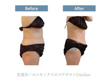 ユニクリア(Uni clear)/上半身・痩身