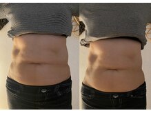 ティーツリー(tea tree)/腸もみ(左)ビフォー(右)アフター