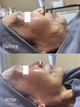 リル(Rire)/サーマトリックス/上尾　60代