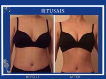 ビテュセスリー はなみずき店(美tusais3)/【美人バスト松山】バストアップ