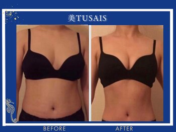 ビテュセスリー はなみずき店(美tusais3)/【美人バスト松山】バストアップ