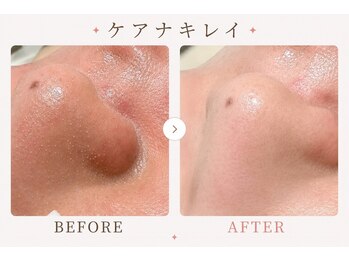 パールプラス 伊勢店(Pearl plus)/毛穴汚れが浮き出る!!