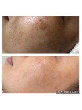 レイラニア(Leilani.Am)/しみケア【デトックス】