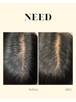 ニード(NEED)/頭皮のビフォーアフター