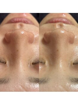 スピカ(Spica)/夏前の毛穴ケア!