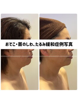 リジェ(Rege)/50代女性の方　施術