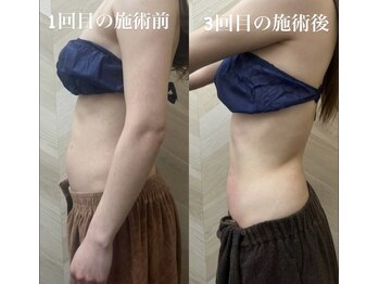 介正鍼灸整骨院 整体院 エフコープ大野城店/痩身エステ＊ラジオ波／キャビ