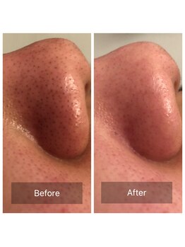 リュミエール デスポワール(Lumiere d'espoir)/毛穴洗浄