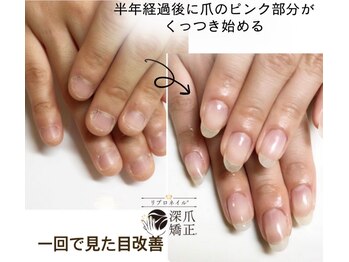 ティアラネイル 宇都宮/リプロネイル深爪矯正