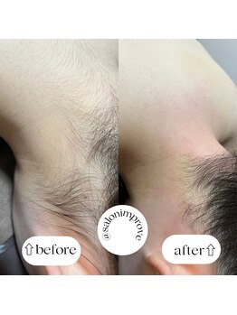 サロン インプルーヴ 久留米店(Salon improve)/うなじワックス脱毛+SHR光脱毛
