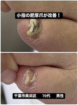 肥厚爪による痛みから解放